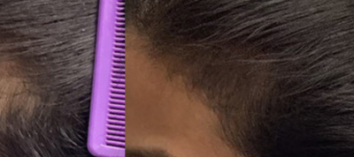 After 2 hair treatments — patient 1
