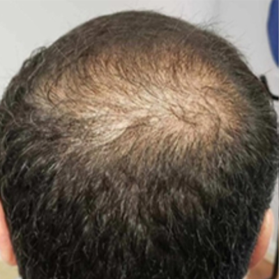 Before hair treatment — patient 2