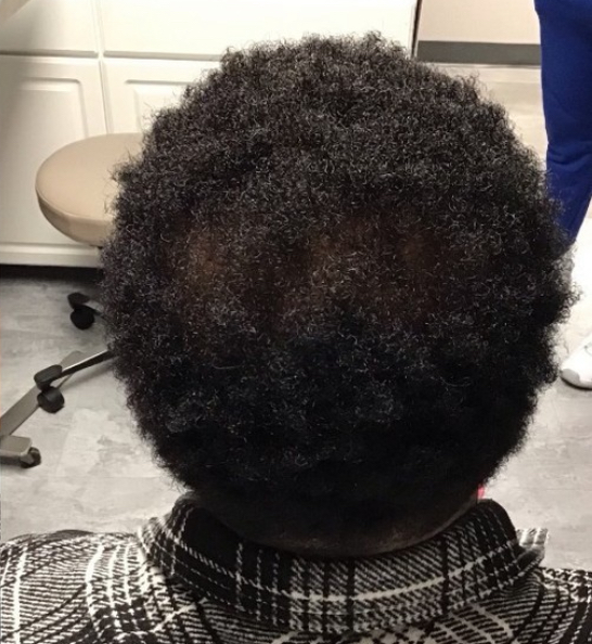After 2 hair treatments — patient 4