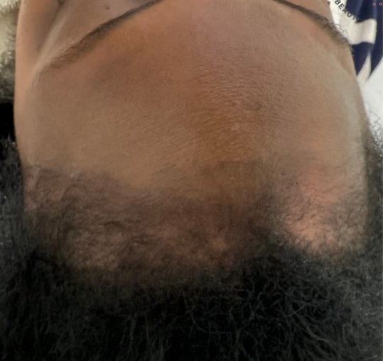 Before hair treatment — patient 3