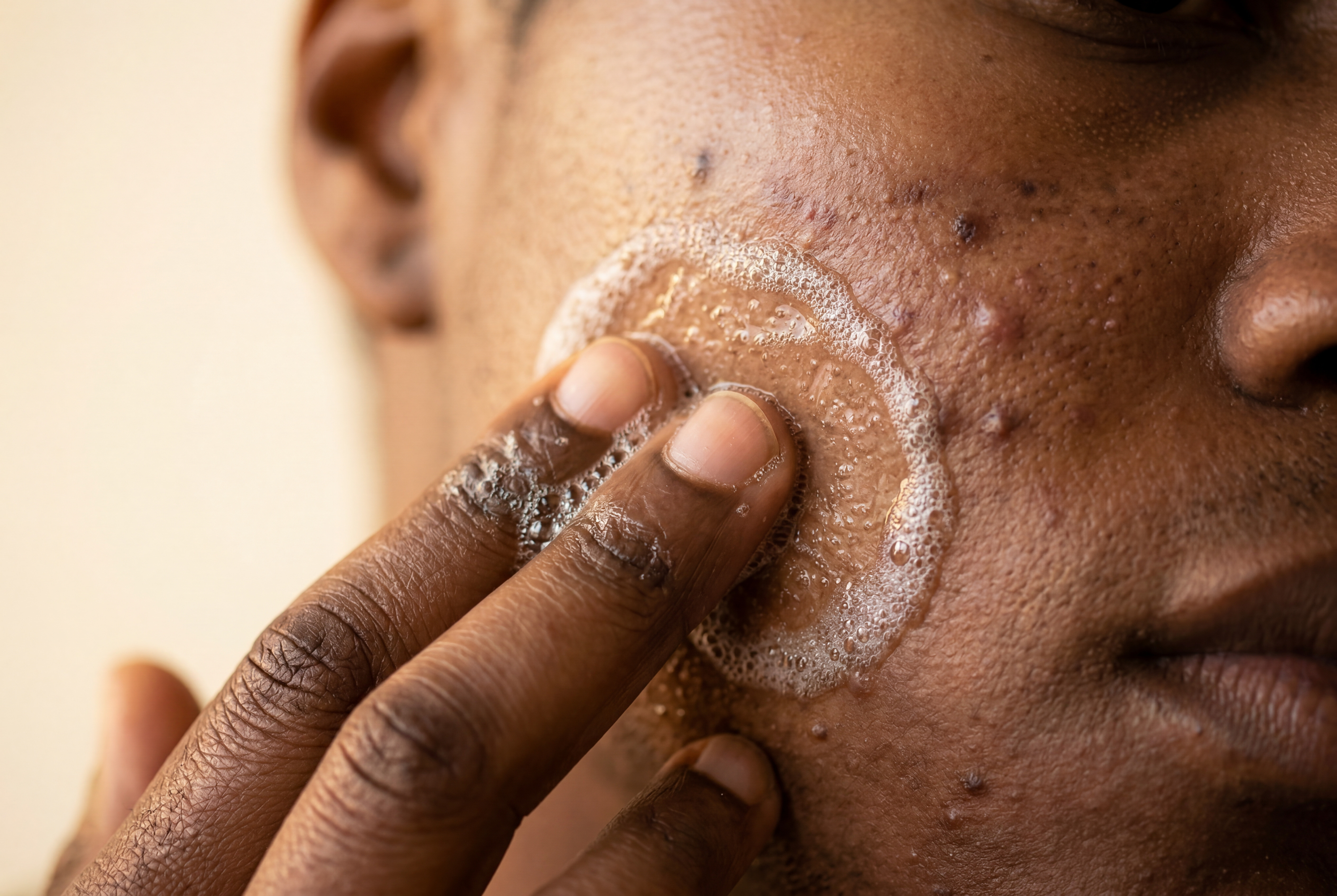 Acne and Hyperpigmentation